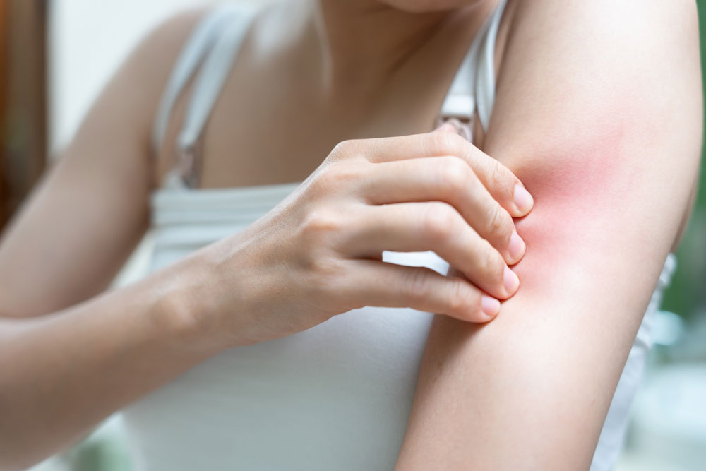 Young woman scratch body has itchy skin from skin allergic