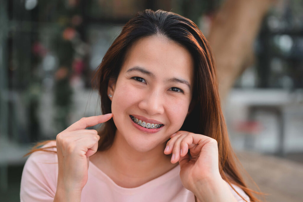 Dental braces on the teeth of a young beautiful woman