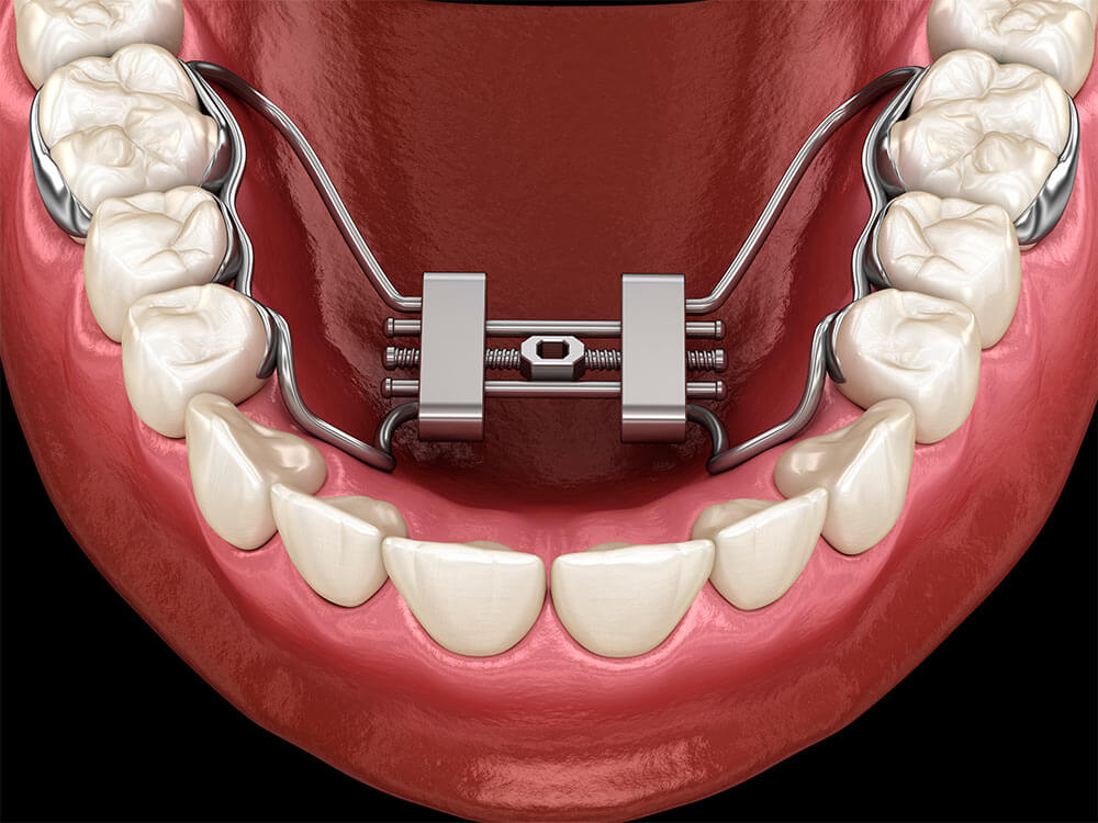 Palo Alto's Rapid Palatal Expander (RPE)