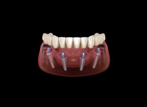 Mandibular prosthesis All on 4 system supported by implants