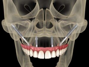 Zygomatic Implants