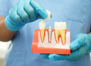 Doctor holding dental implant