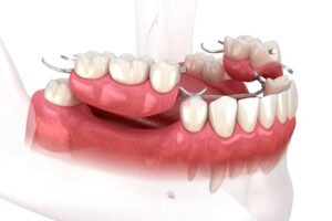 Dentures
