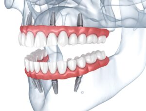 Prostheses supported by 8 implants