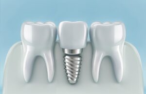Same-Day Dental Implants