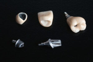 Different,Types,Of,Treatments,Dental,Implant