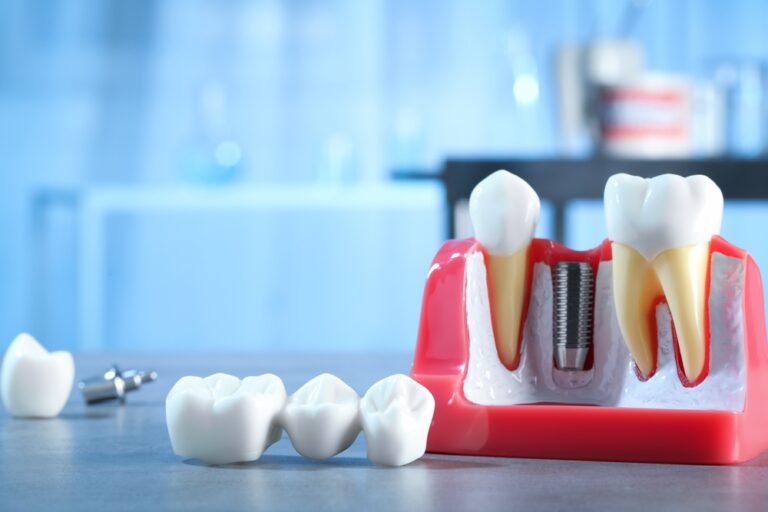 Educational,Model,With,Post,Of,Dental,Implant,Between,Teeth,And
