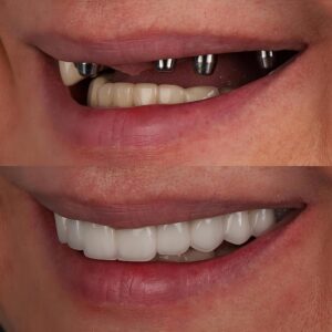 In,Dental,Implant,Jaw,Surgery,Treatment,,The,All-on-4,Or,All-on-x,