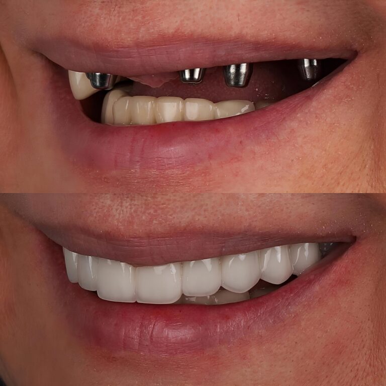 In,Dental,Implant,Jaw,Surgery,Treatment,,The,All-on-4,Or,All-on-x,