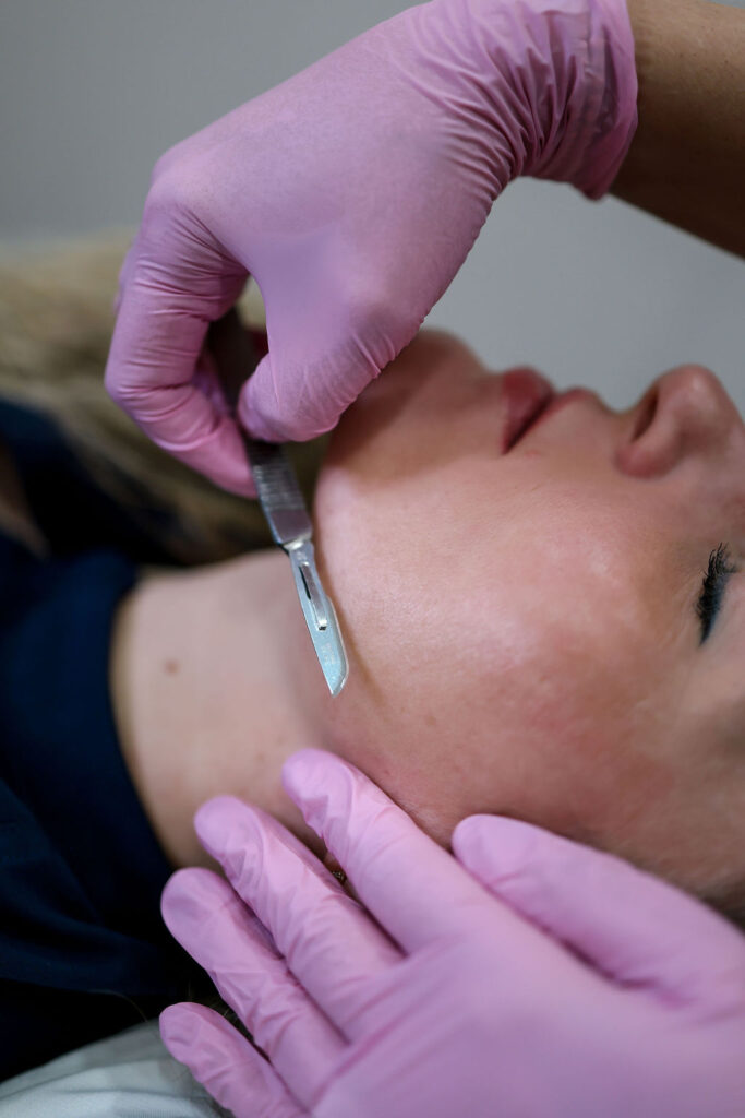 Dermaplaning