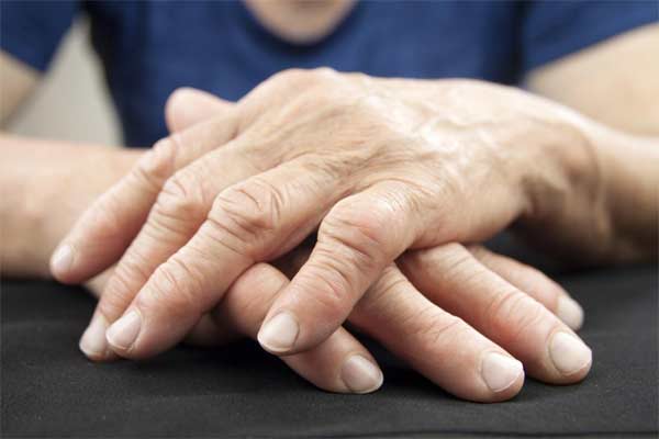 Arthritis Hands
