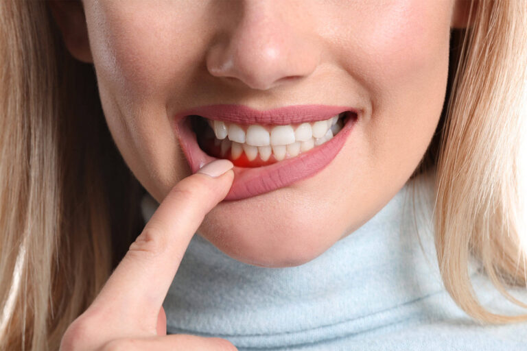 Periodontal (Gum) Disease