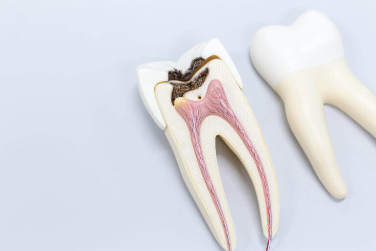 Root Canal