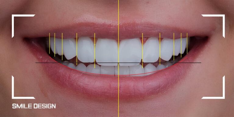 Smile Design Makeover