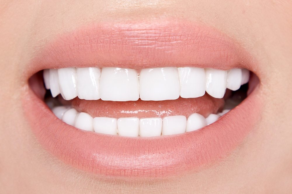 full-view-veneers