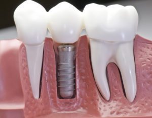 implant-dental