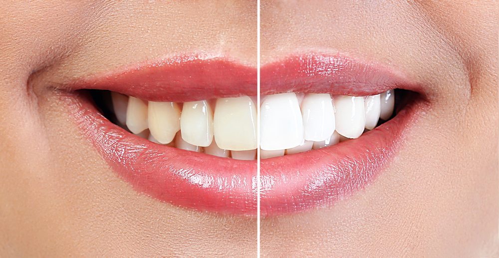 whitening-process