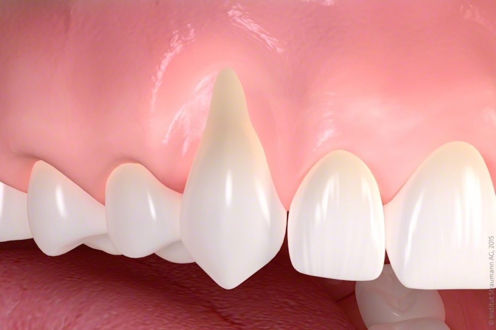 Gum_recession_treatment
