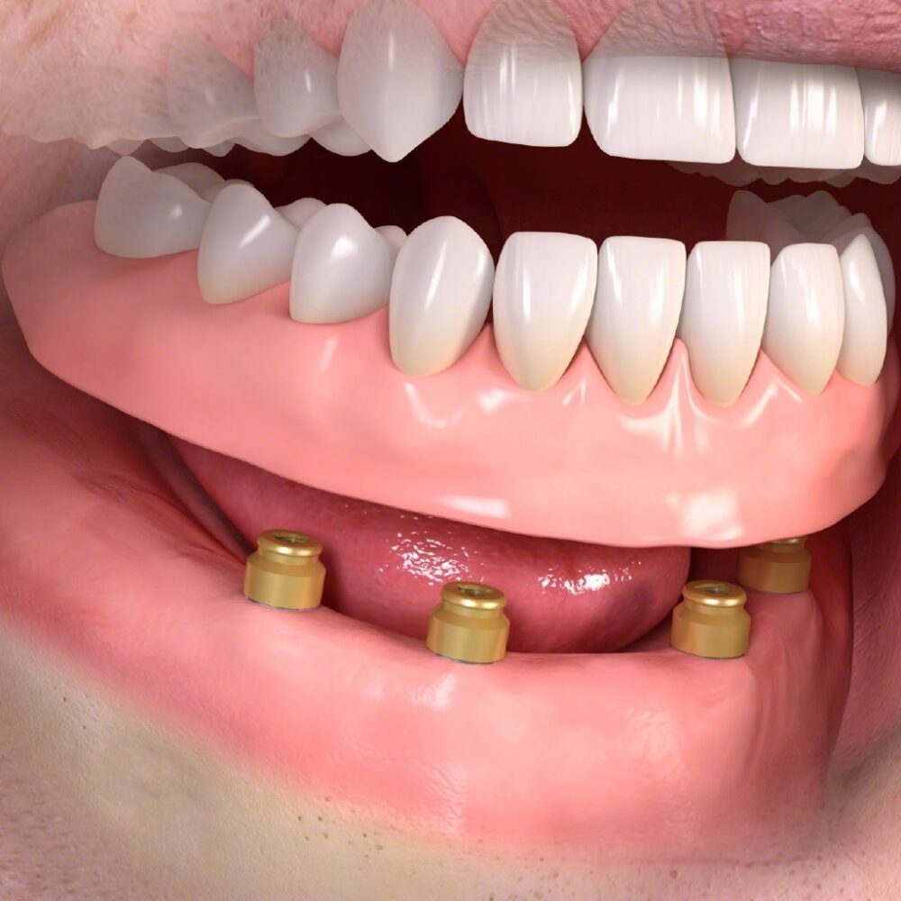 Removable_denture_LOCATOR_attachment_03-2