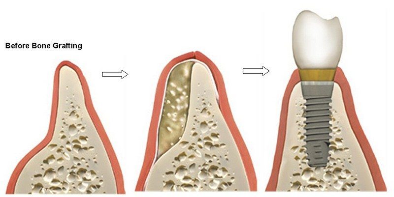 bone-grafting