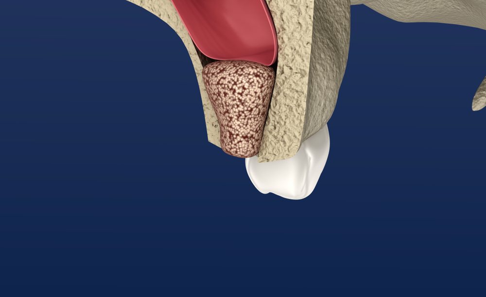 sinus-lift
