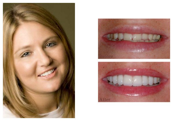 smile gallery before and after