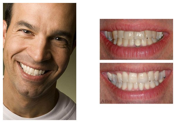 smile gallery before and after