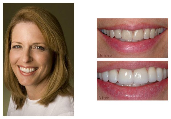 smile gallery before and after