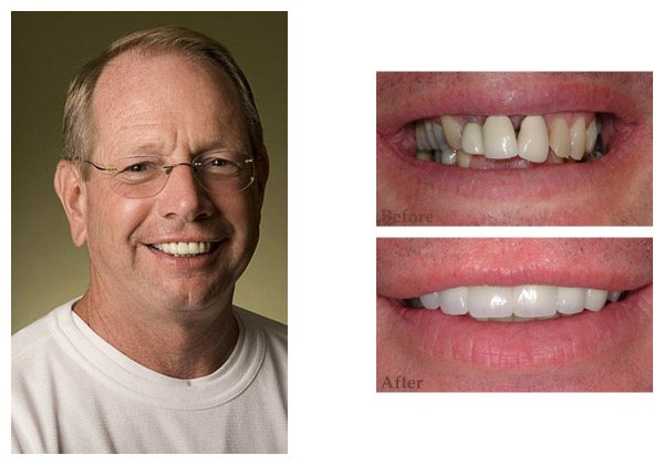 smile gallery before and after