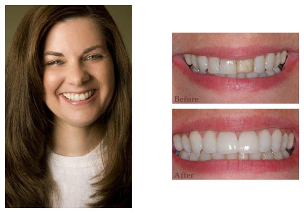 smile gallery before and after