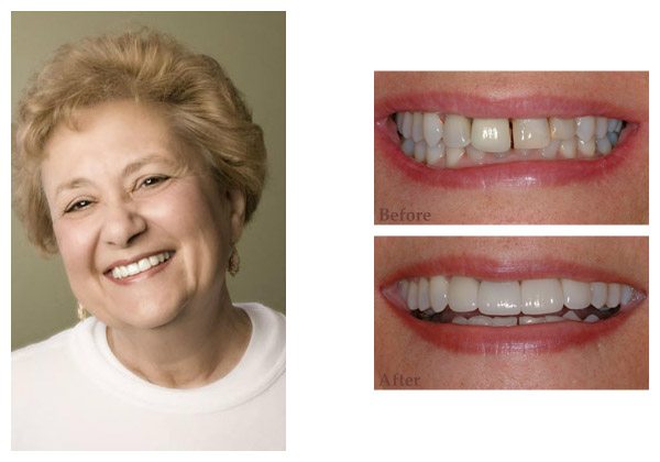 smile gallery before and after