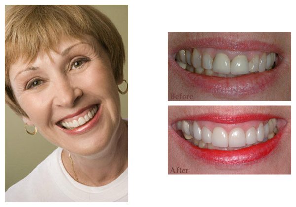 smile gallery before and after