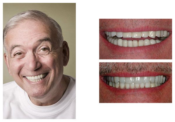 smile gallery before and after