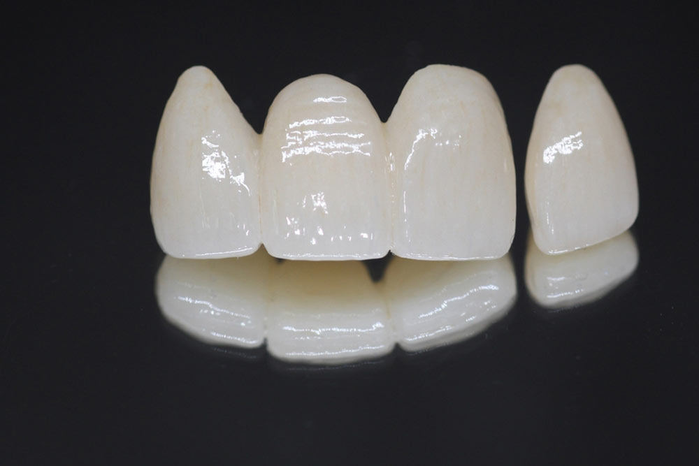 Durathin_Prepless_Veneers