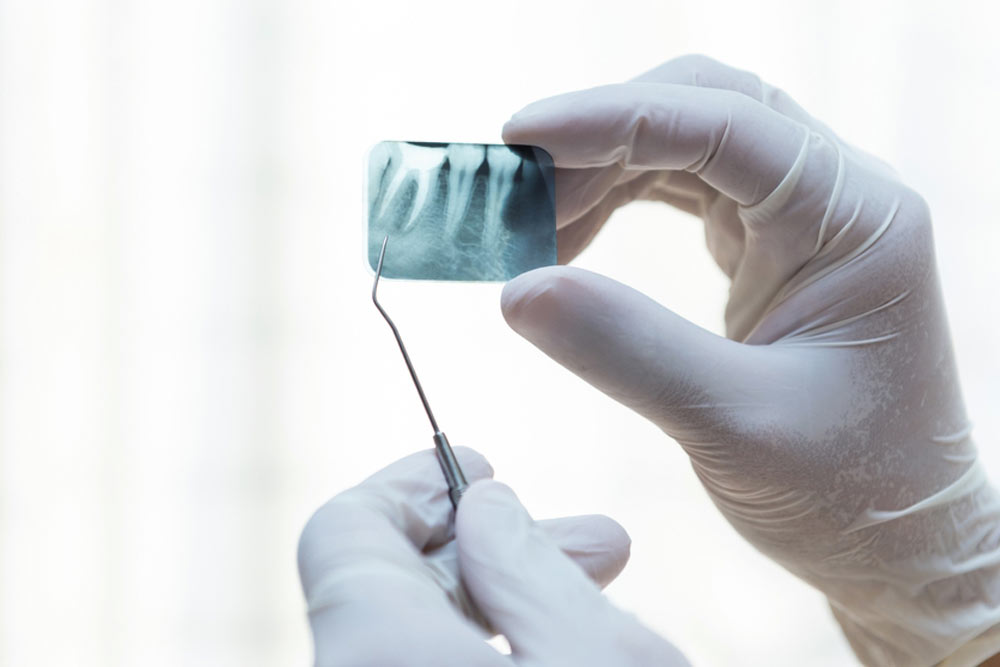 Periodontics, Bone Grafting
