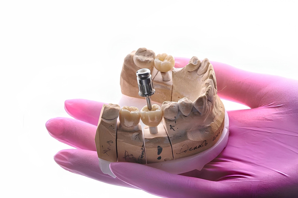 Intraosseous dental implant treatment. Bone grafting for tooth loss and intraosseous cylindrical dental titanium implants for tooth loss
