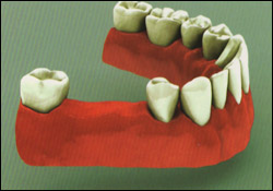 multiple_tooth_implant