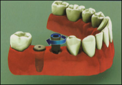 multiple_tooth_implant