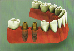 multiple_tooth_implant