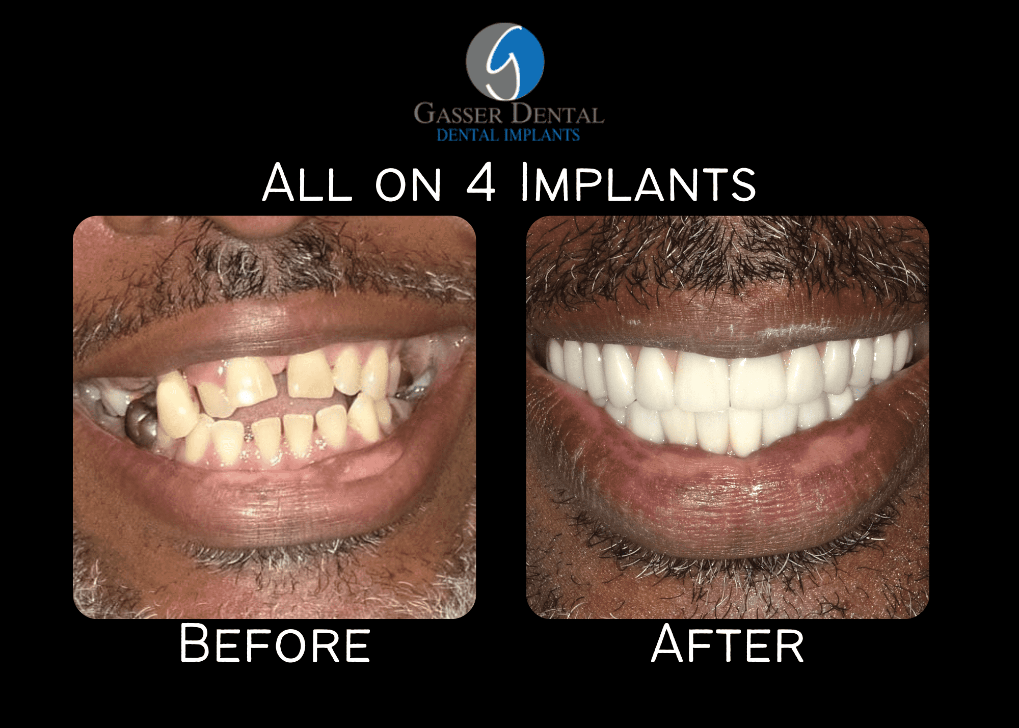 all on 4 implants before and after