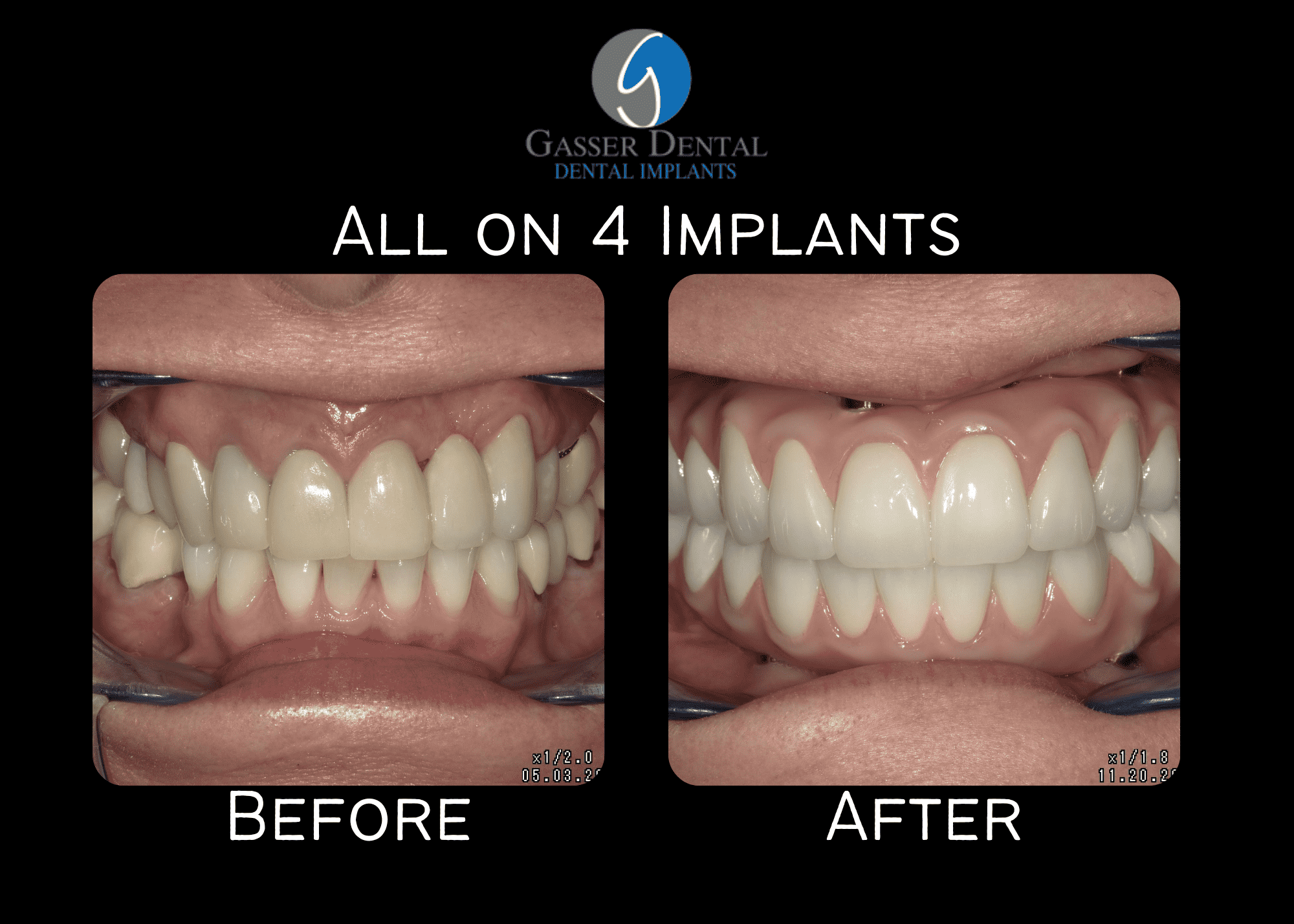 all on 4 implants before and after