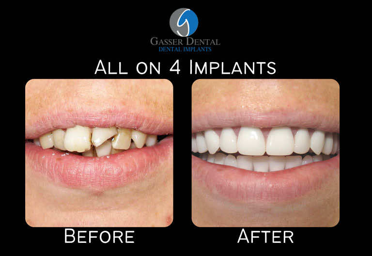 all on 4 implants before and after
