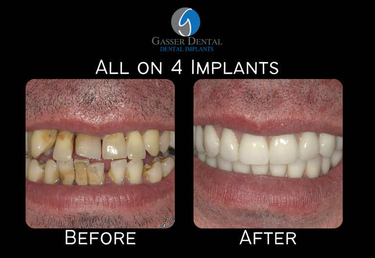 all on 4 implants before and after