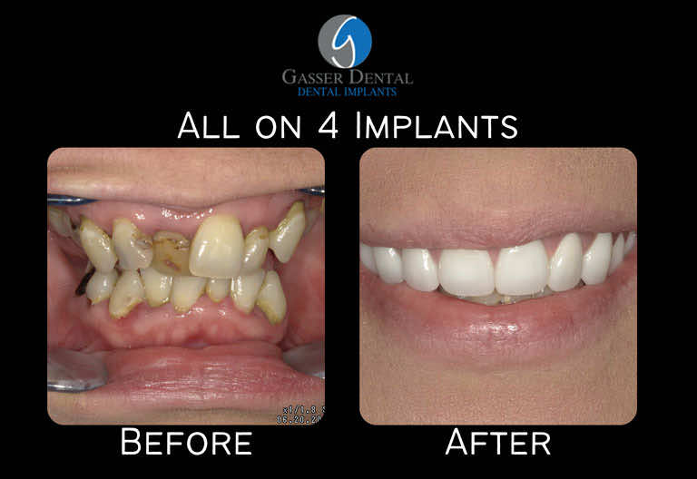 all on 4 implants before and after
