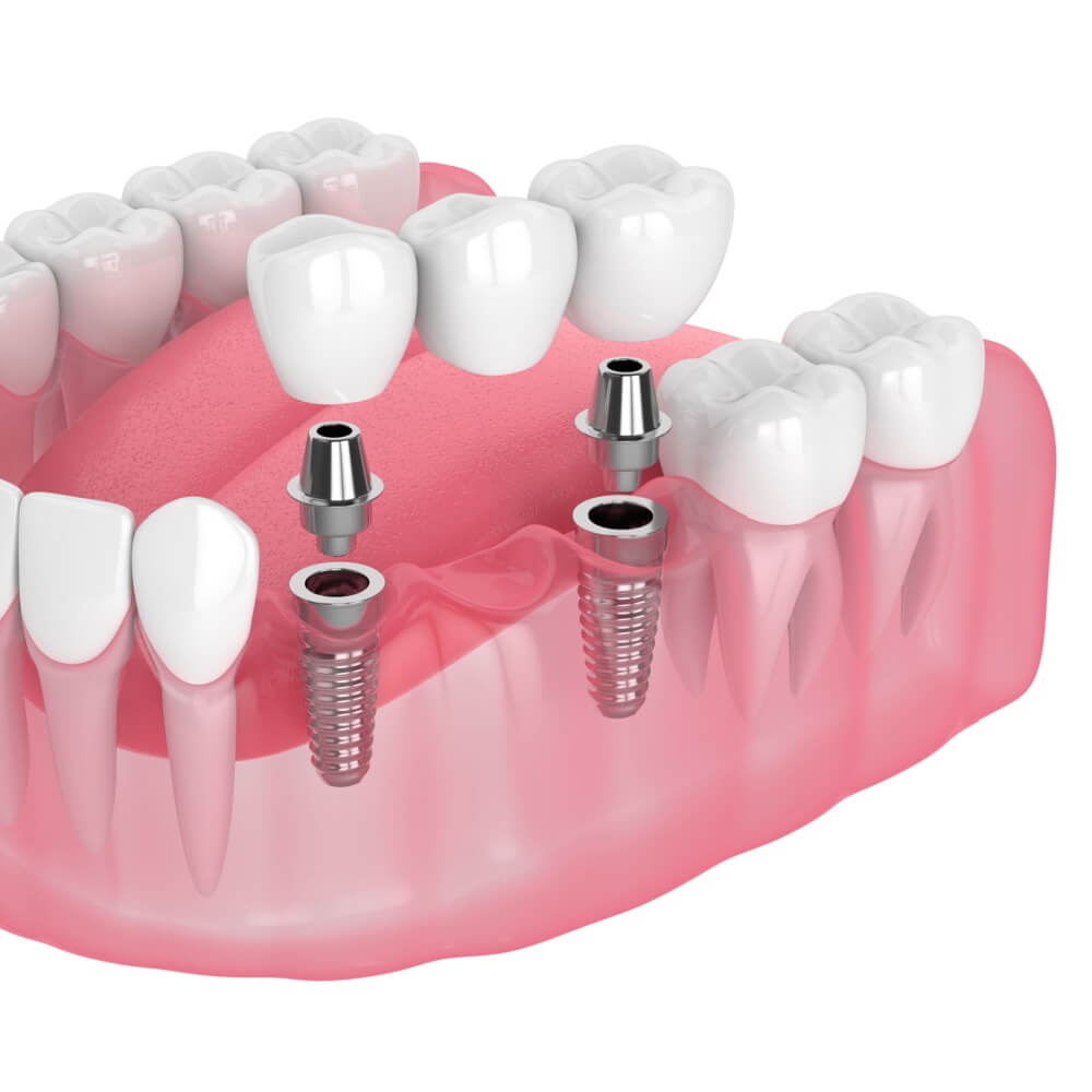 3d render of jaw with implants supported dental bridge isolated over white background