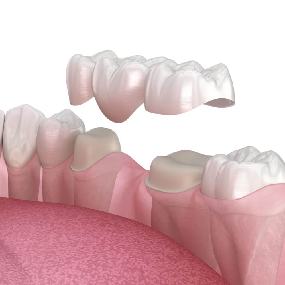 Dental bridge of 3 teeth over molar and premolar. Medically accurate 3D illustration of human teeth treatment