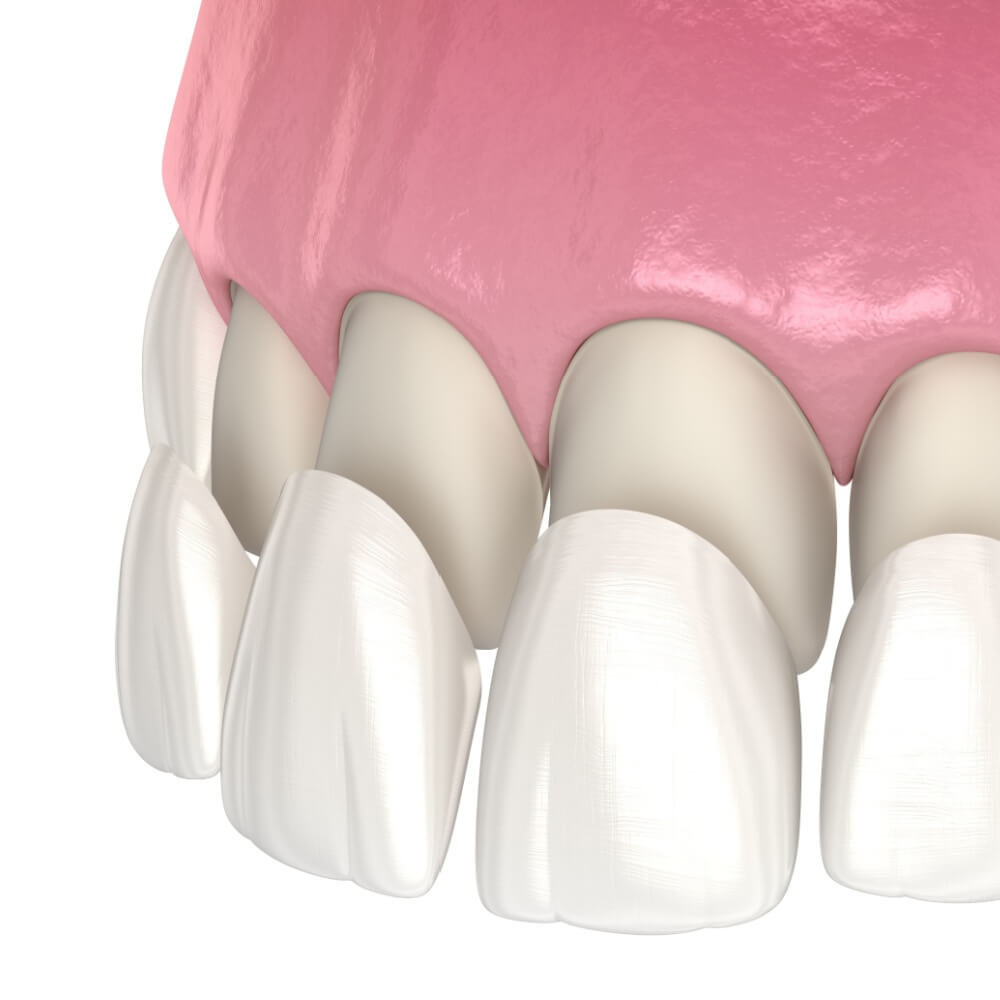 Veneer installation procedure over central incisor and lateral incisor