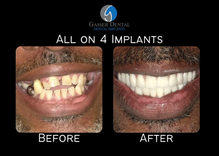 all on 4 implants before and after
