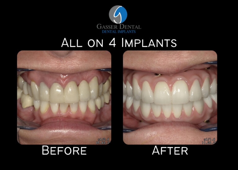 all on 4 implants before and after