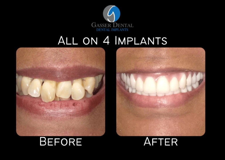 all on 4 implants before and after
